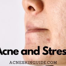 Stress and Acne