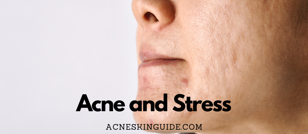 Stress and Acne