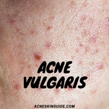 Acne Vulgaris