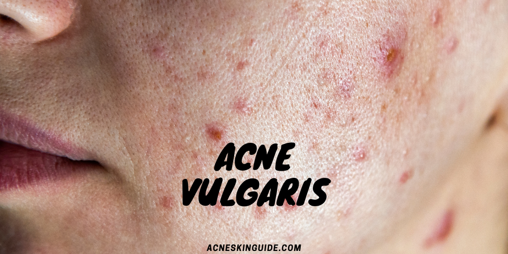 Acne Vulgaris