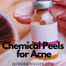 Chemical Peels for Acne