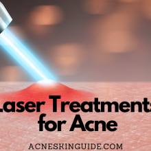 Laser Treatments for Acne