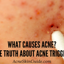 What Causes Acne