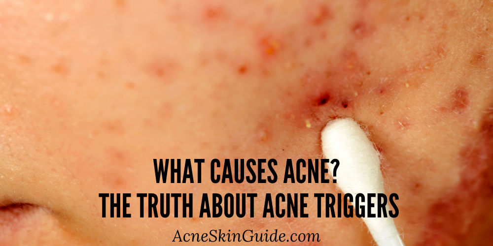 What Causes Acne