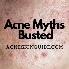 Acne Myths Busted