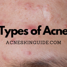 Types of Acne