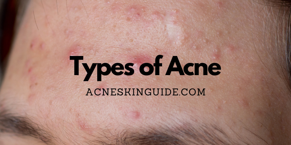 Types of Acne
