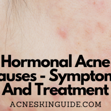 Hormonal Acne