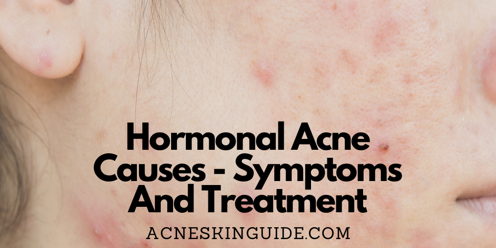 Hormonal Acne