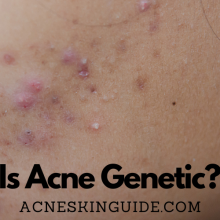 Is Acne Genetic