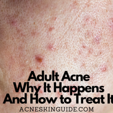 Adult Acne