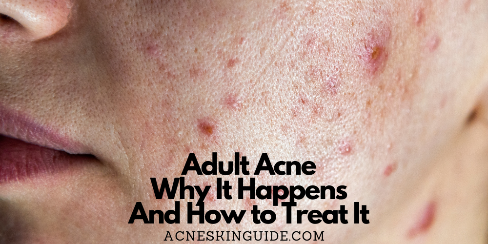 Adult Acne