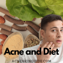 Acne and Diet