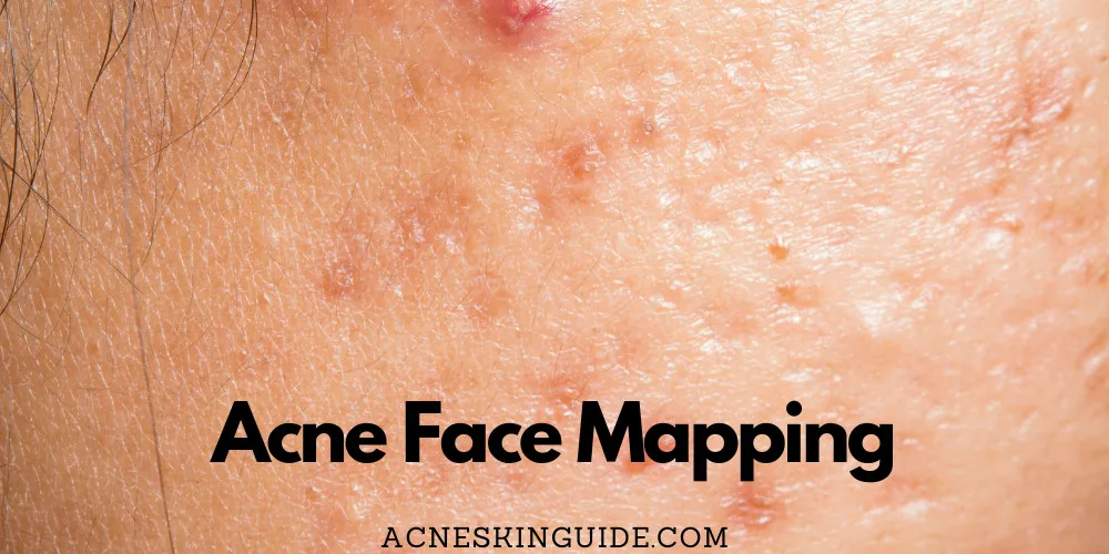 Acne Face Mapping