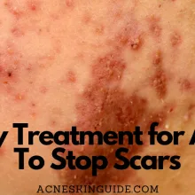 Early Treatment for Acne