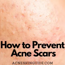 How to Prevent Acne Scars
