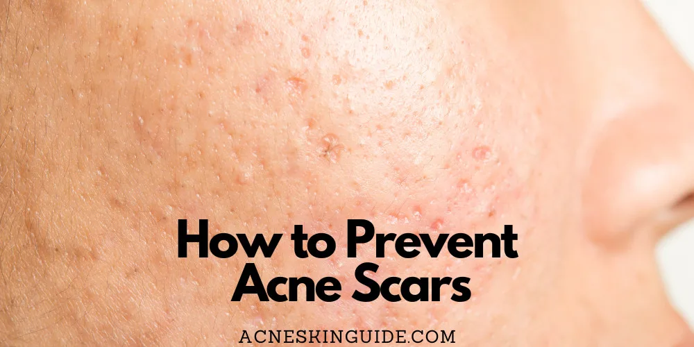 How to Prevent Acne Scars
