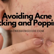 Avoiding Acne Picking and Popping