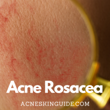 Acne Rosacea