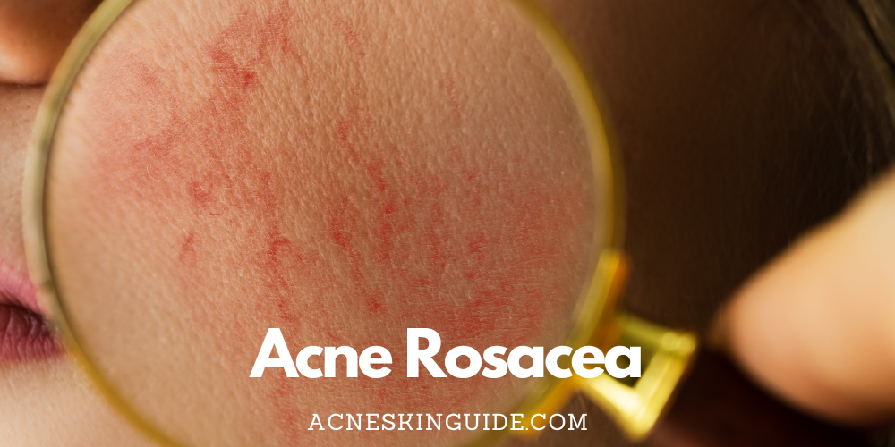 Acne Rosacea