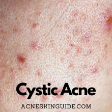Cystic Acne