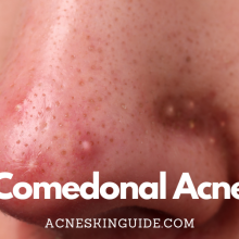 Comedonal Acne