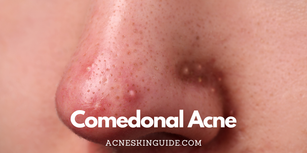 Comedonal Acne