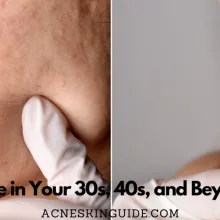 Acne in Your 30s, 40s, and Beyond
