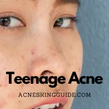 Teenage Acne