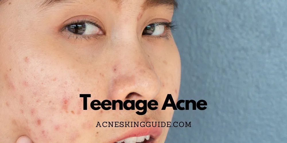 Teenage Acne