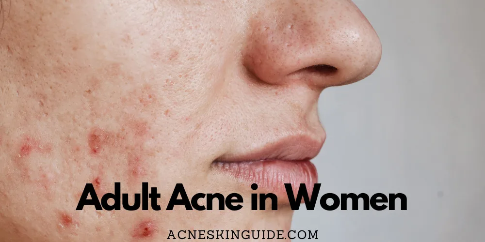 Adult Acne in Women