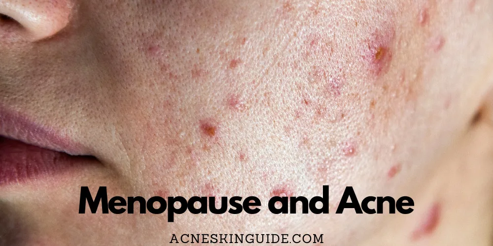Menopause and Acne