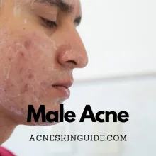 Male Acne