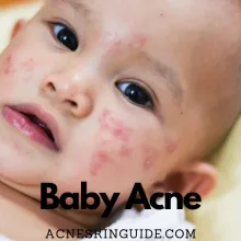 Baby Acne