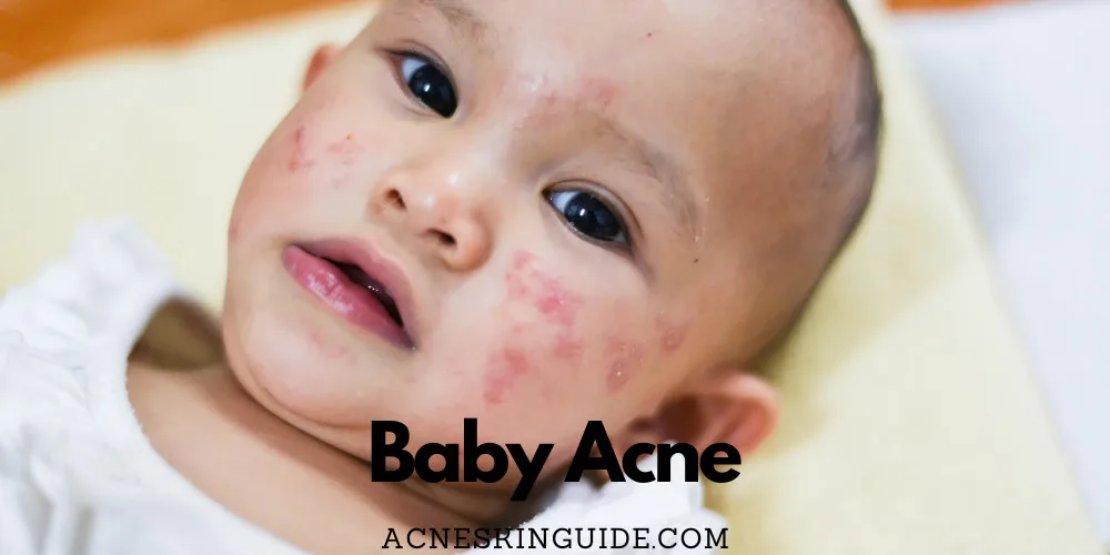 Baby Acne