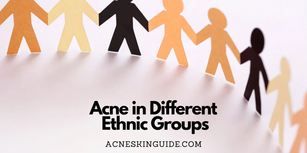 Acne in Different Ethnic Groups