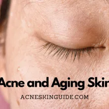 Acne and Aging Skin