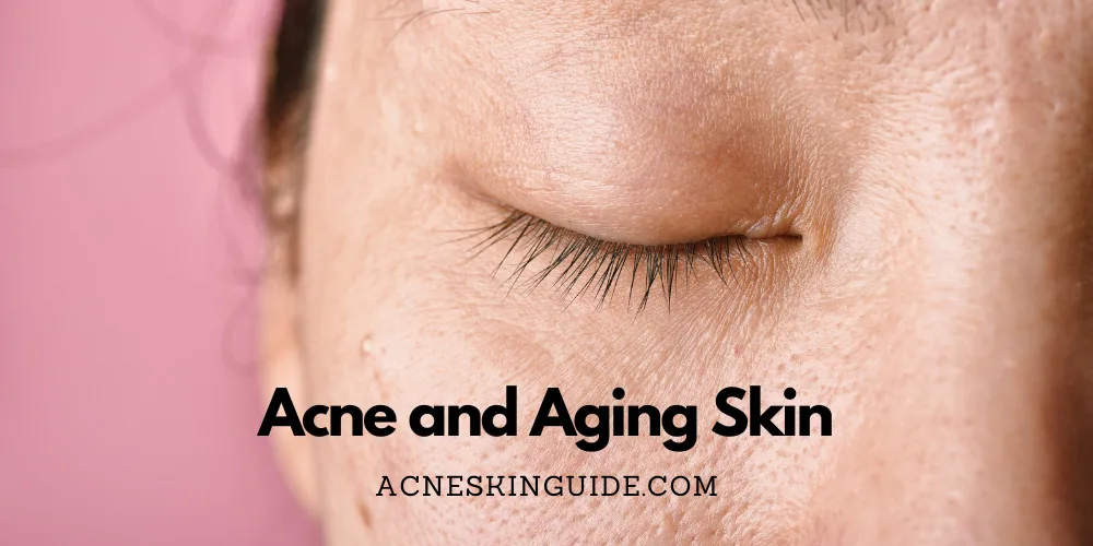 Acne and Aging Skin