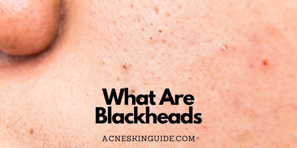 What Are Blackheads
