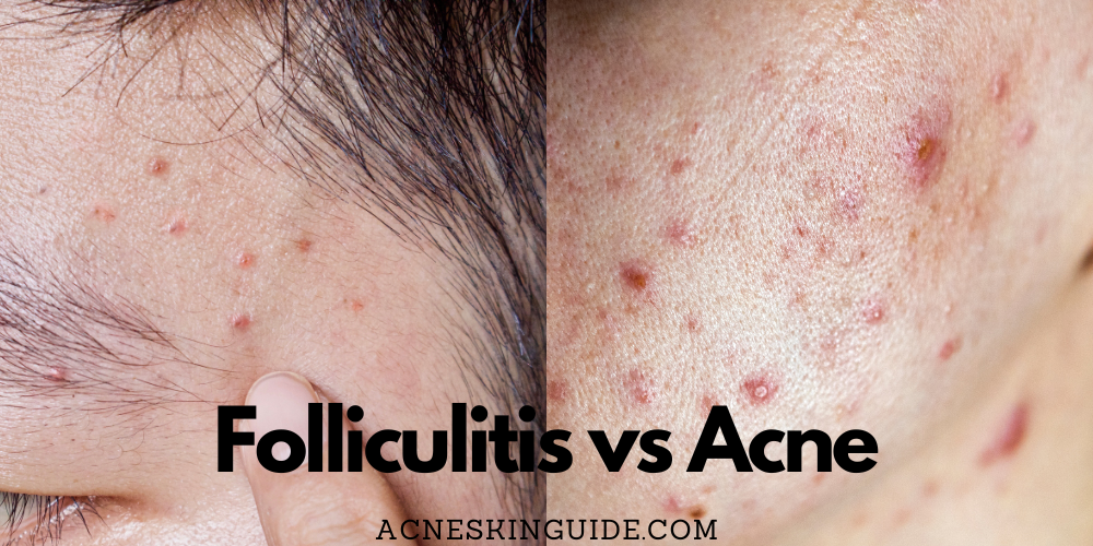 Folliculitis vs Acne