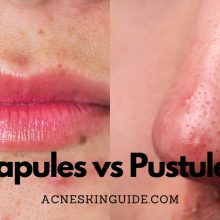 Papules vs Pustules