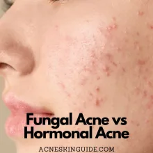 Fungal Acne vs Hormonal Acne
