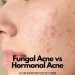 Fungal Acne vs Hormonal Acne