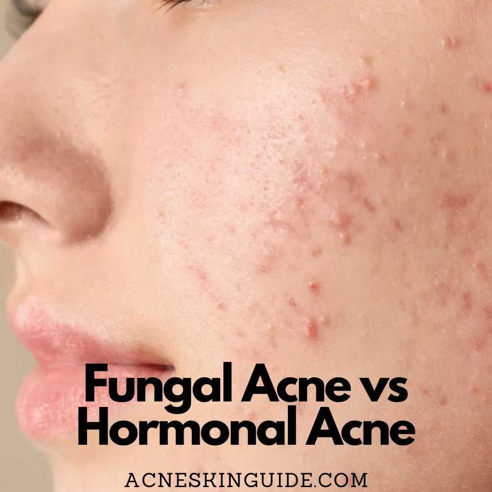 Fungal Acne vs Hormonal Acne