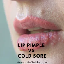 Lip Pimple vs Cold Sore